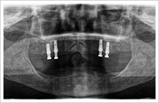 インプラント症例