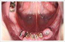 入れ歯・インプラント症例