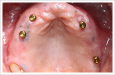 入れ歯・インプラント症例