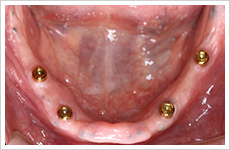 入れ歯・インプラント症例