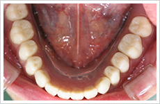 入れ歯・インプラント症例