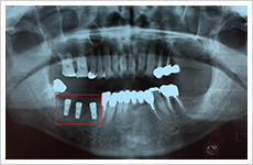 インプラント症例