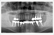 インプラント症例