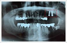 インプラント症例