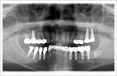 インプラント症例