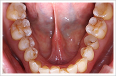 補綴治療の症例