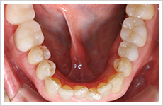 補綴治療の症例