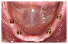 入れ歯・インプラント症例