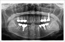 インプラント症例