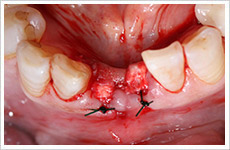 インプラント埋入手術