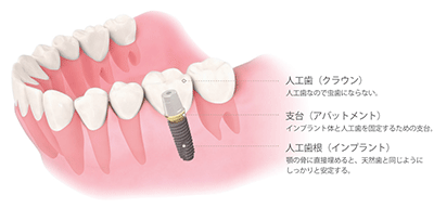 インプラントの構造