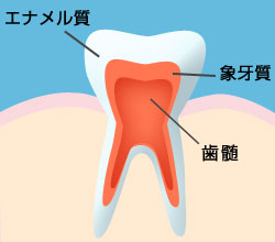 虫歯の進行と治療法