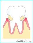 歯肉の炎症