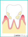 歯周ポケットの形成