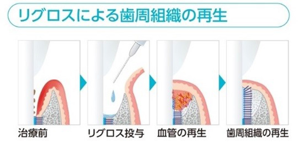 リグロスにより歯周組織の再生イラスト