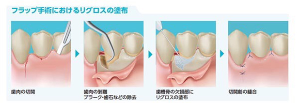 フラップ手術におけるリグロスの塗布