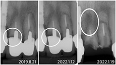 インプラント埋入手術　症例