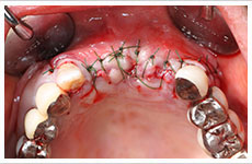 インプラント埋入手術症例